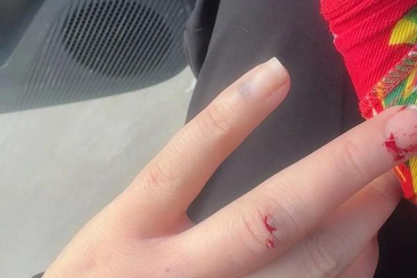 女人梦见狗咬手是要发财 女人梦见狗咬手是要发财