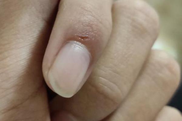 梦见狗抓伤自己的手 梦见狗抓伤自己的手